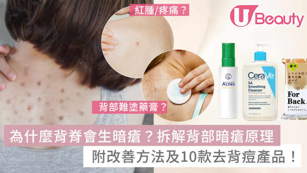 為什麼背脊生暗瘡？背部暗瘡解決方法！附10款去背痘噴霧/沐浴乳