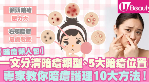 【暗瘡類型分清】囊腫型暗瘡發炎處理、改善暗瘡護理方法懶人包、暗瘡貼暗瘡膏有用？
