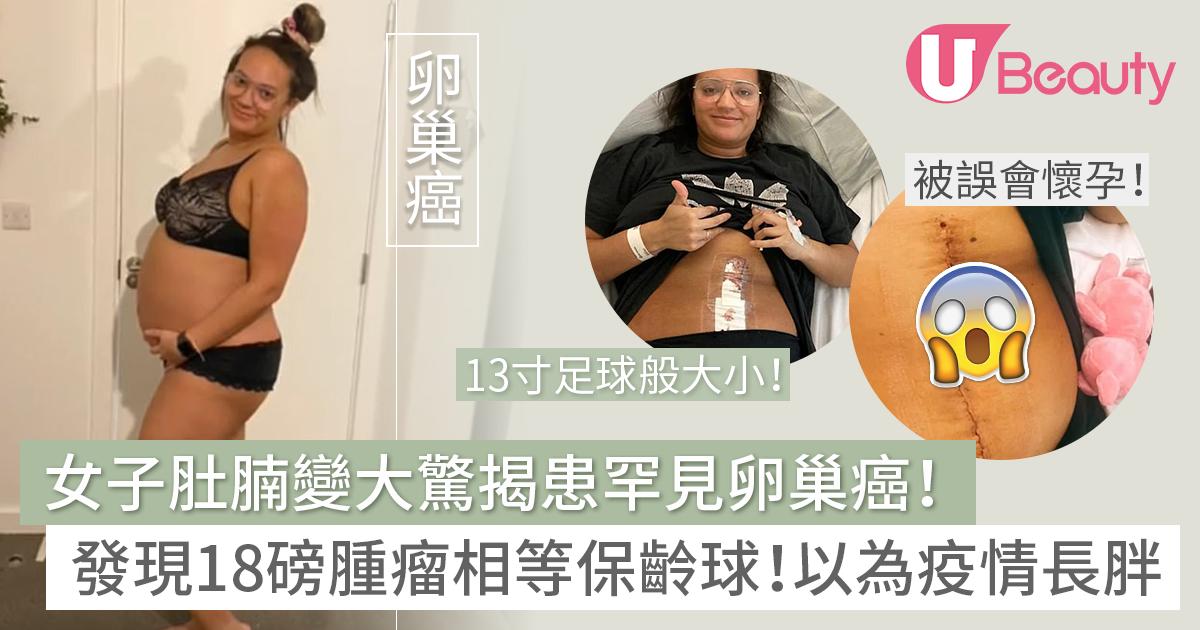 女子肚腩變大驚揭患卵巢癌！驗出18磅腫瘤相等保齡球！以為一般長胖延誤求醫！