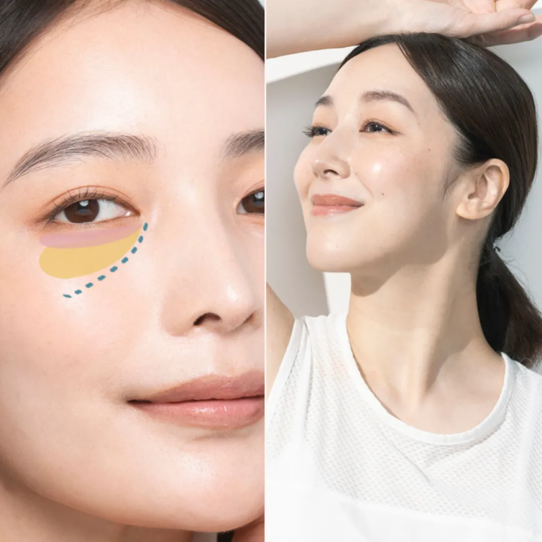 眼袋槍邊間好？速效去眼袋？眼袋槍原理、效果、價錢及副作用全攻略