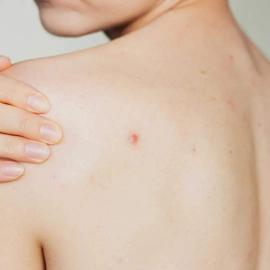 香港脫疣邊間好？(附價錢)一文解析脫疣治療！脫疣後注意事項/除疣後護理