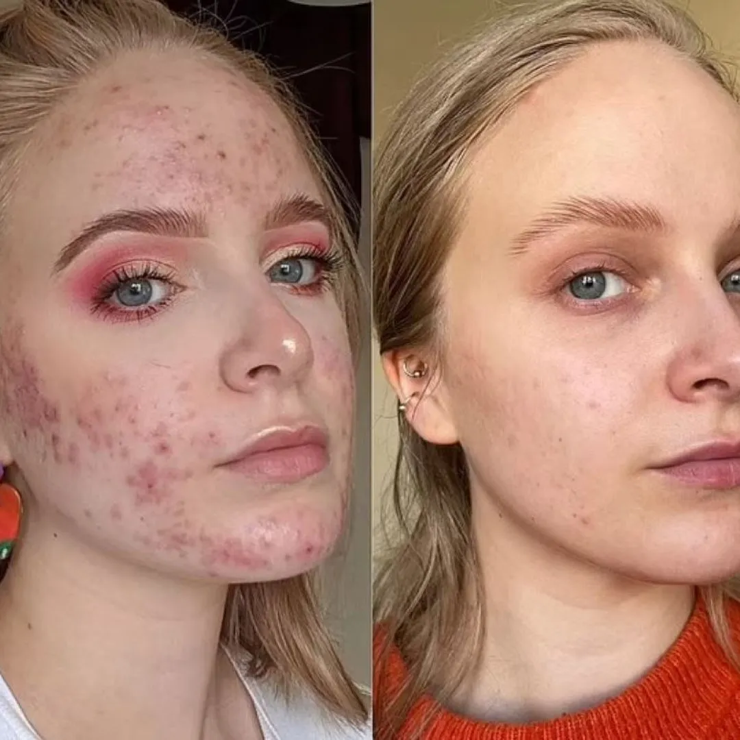 24歲女吃避孕藥引暗瘡爆發！嚴重程度連醫生也嚇到！皮膚科醫生：避孕藥有副作用！