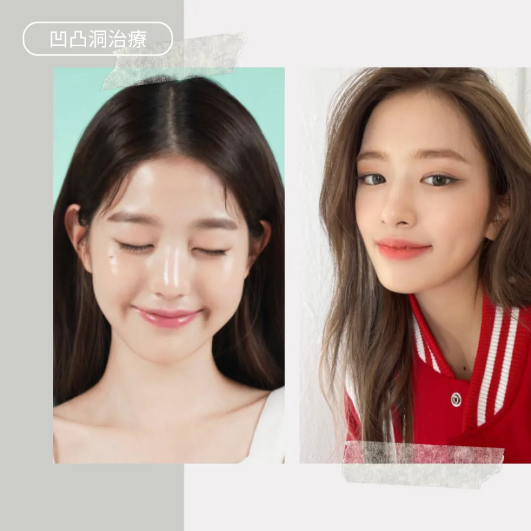 凹凸洞治療｜凹凸洞成因類型、解決方法一文看清：激光/微針/去凹凸洞藥膏