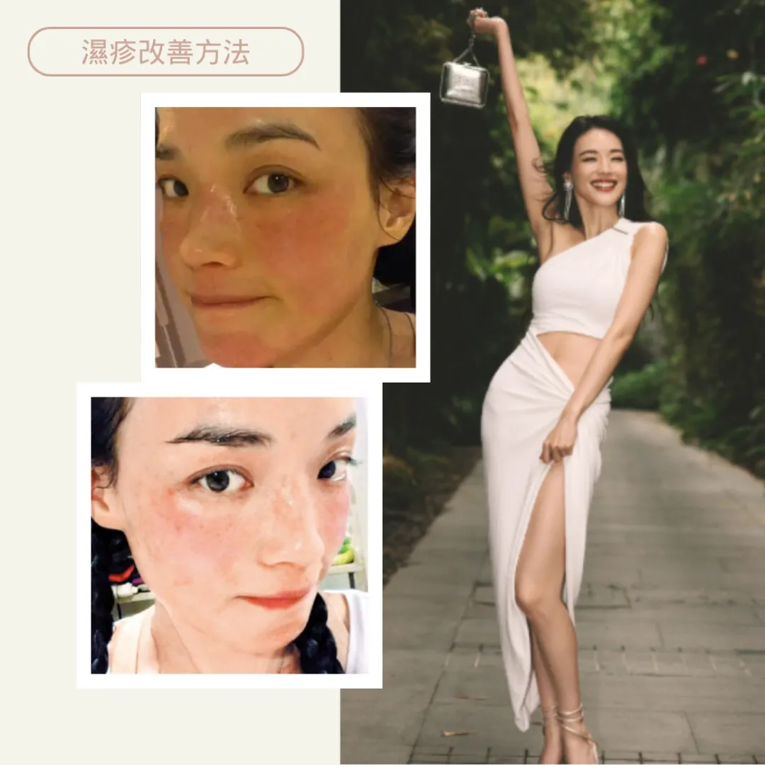 濕疹症狀、原因一文看清！7大止癢改善方法＋中醫戒口飲食建議