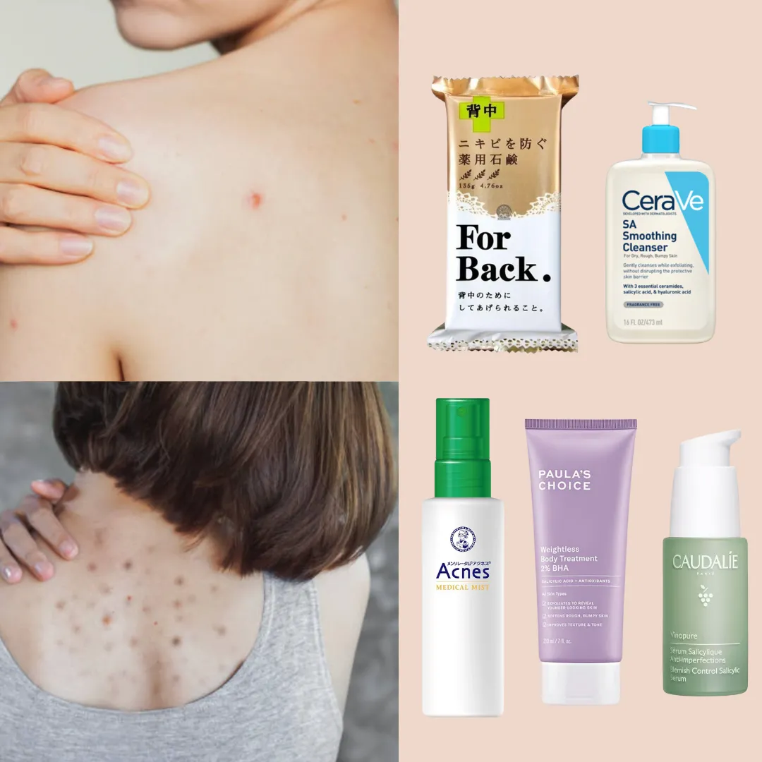 為什麼背脊生暗瘡？背部暗瘡解決方法！附10款去背痘噴霧/沐浴乳