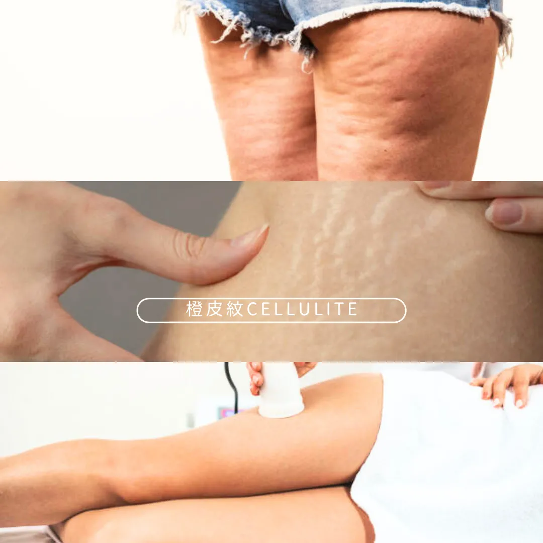 為什麼有橙皮紋？6方法比塗藥膏激光醫美更助清除橙皮紋