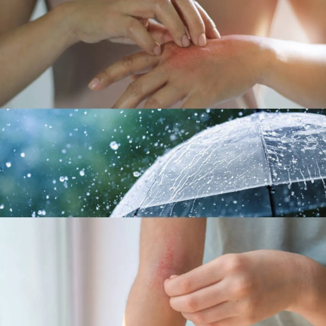 落雨令皮膚易敏感出濕疹？10招改善濕疹痕癢！6款防敏濕疹護膚品推薦附評價