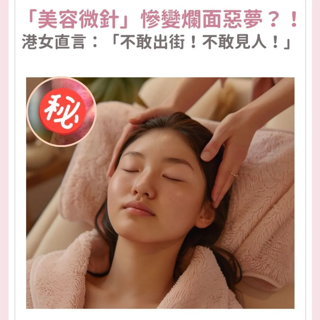美容微針後接近毀容！白滑美肌變爛面肌？！準新娘事主直言：成面紅腫化膿 不知點見人！