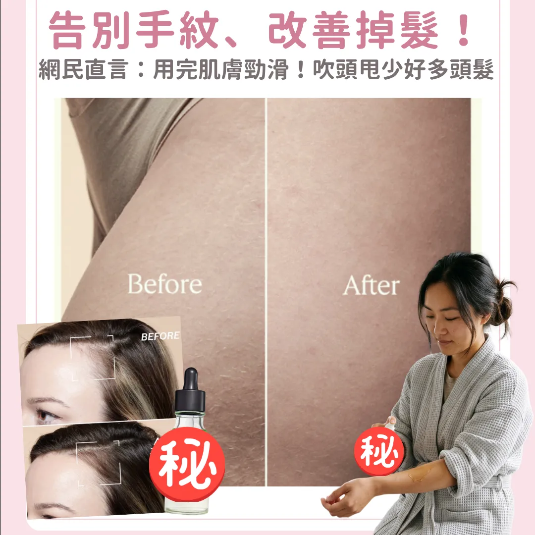 告別手紋、改善掉髮！Threads瘋傳身體減紋好物直言：用完肌膚勁滑、連防脫髮精華都想囤貨！