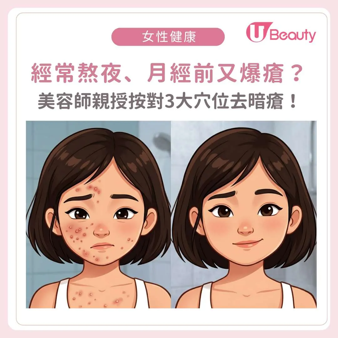 去暗瘡｜美容師親授「3分鐘按手去暗瘡法」！按對3大穴位重拾光滑肌膚！