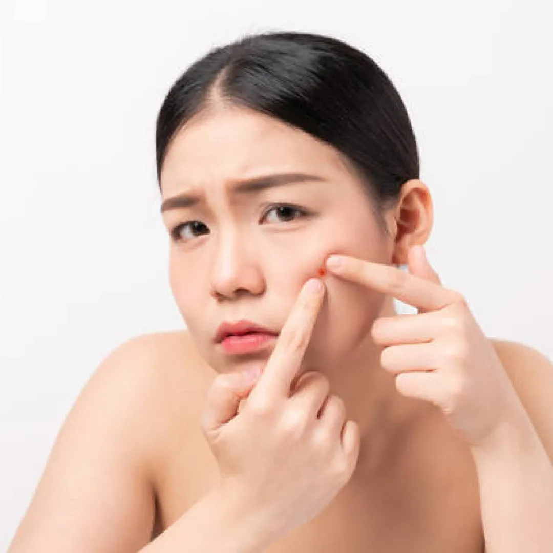 皮膚科醫生揭10個「越搞越衰」護膚壞習慣！打破爛面暗瘡惡性循環！