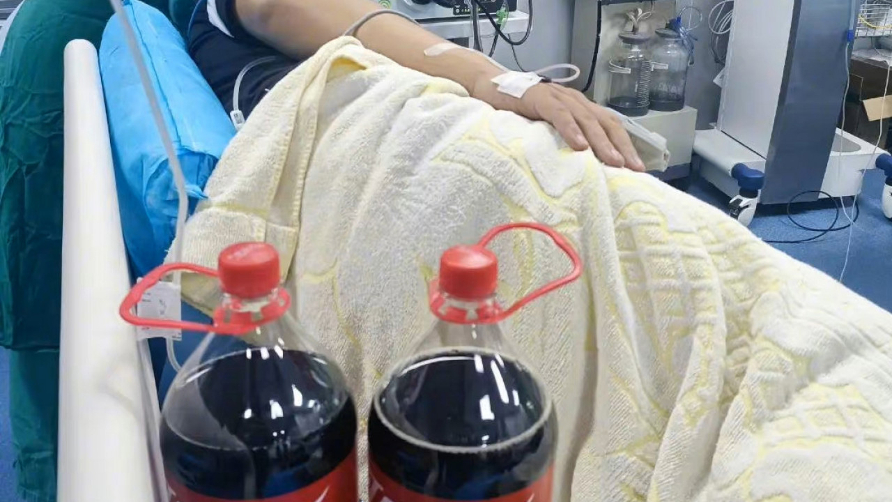 生胃結石醫生藥單開兩支大可樂 男子連續飲一星期後胃結石消失