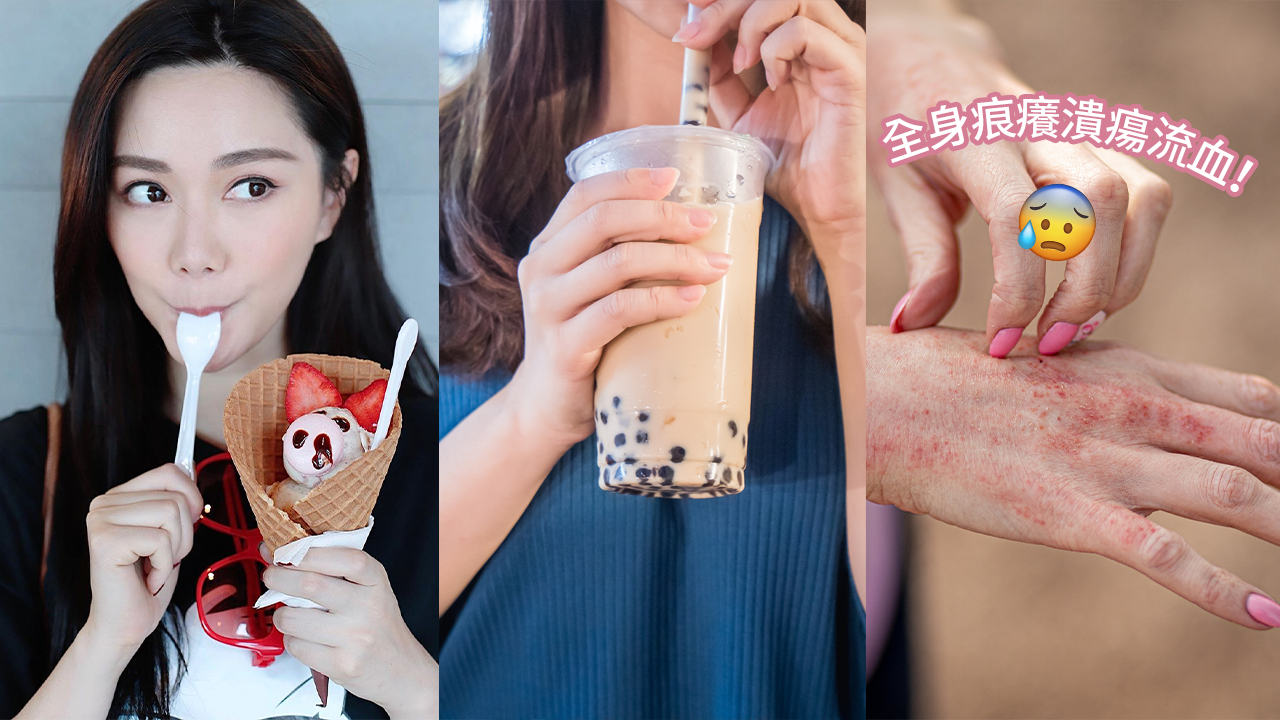 愛喝珍珠奶茶導致嚴重皮膚炎！濕疹痕癢全身潰瘍流血！營養師警告女性要戒這類飲料！