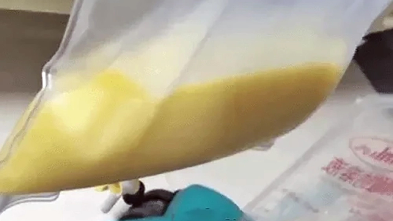 14歲女童抽出2公升「白色血液」求醫揭因零食當正餐致胰臟炎高血脂症