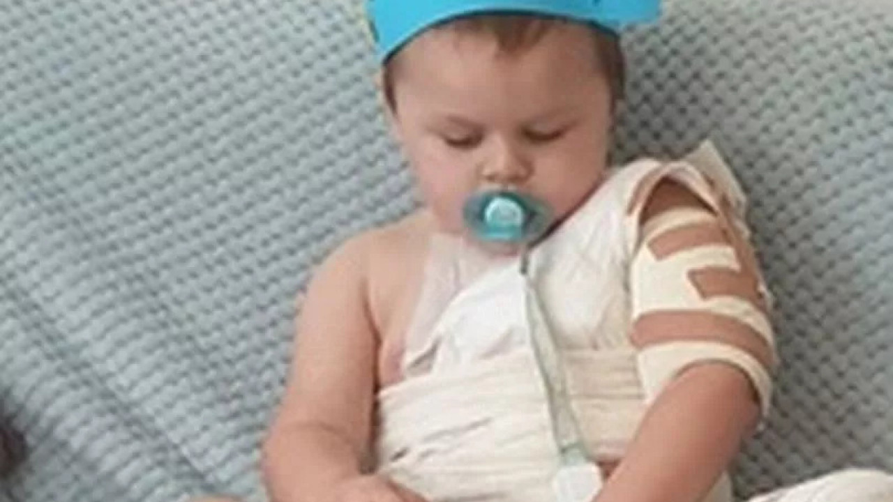 2歲男童意外倒瀉熱咖啡 致3級燙傷皮膚當場剝落