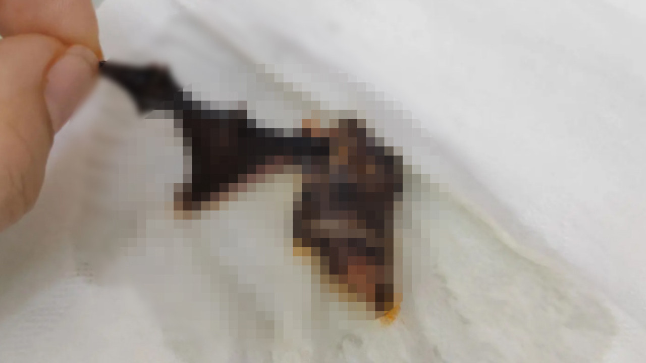 女童食麻辣燙咬到黑色異物　細看竟是蝙蝠／連夜去醫院洗胃