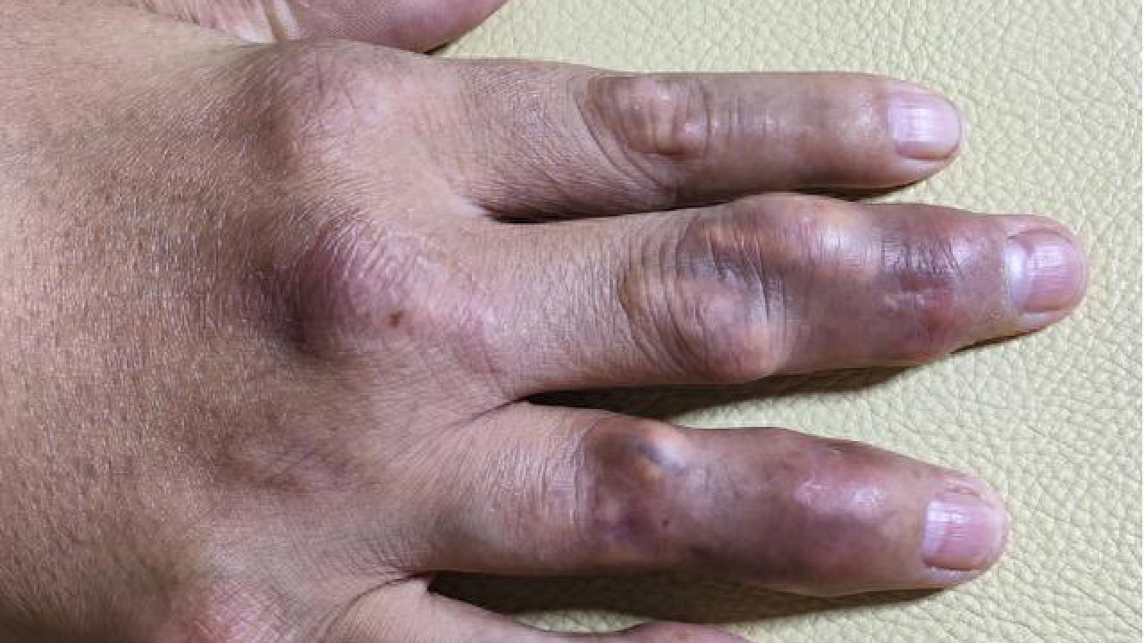 32歲男一個飲食習慣 手指關節生滿痛風石
