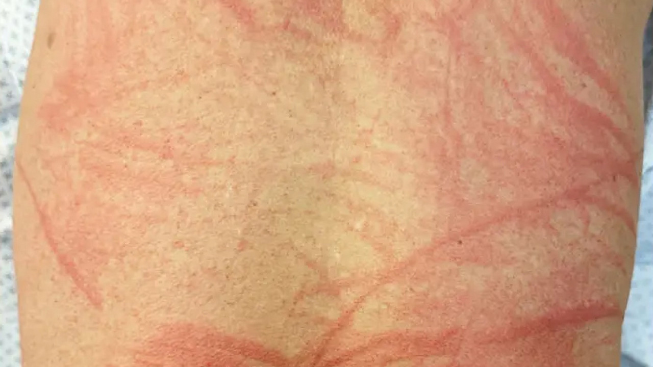 飯後全身出紅疹似被鞭打 注意一事防香菇皮膚炎上身