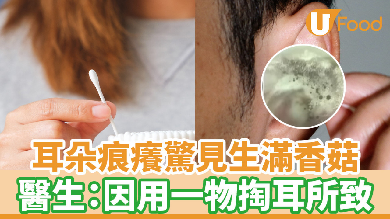 耳朵痕癢驚見生滿香菇 醫生：因用一物掏耳所致