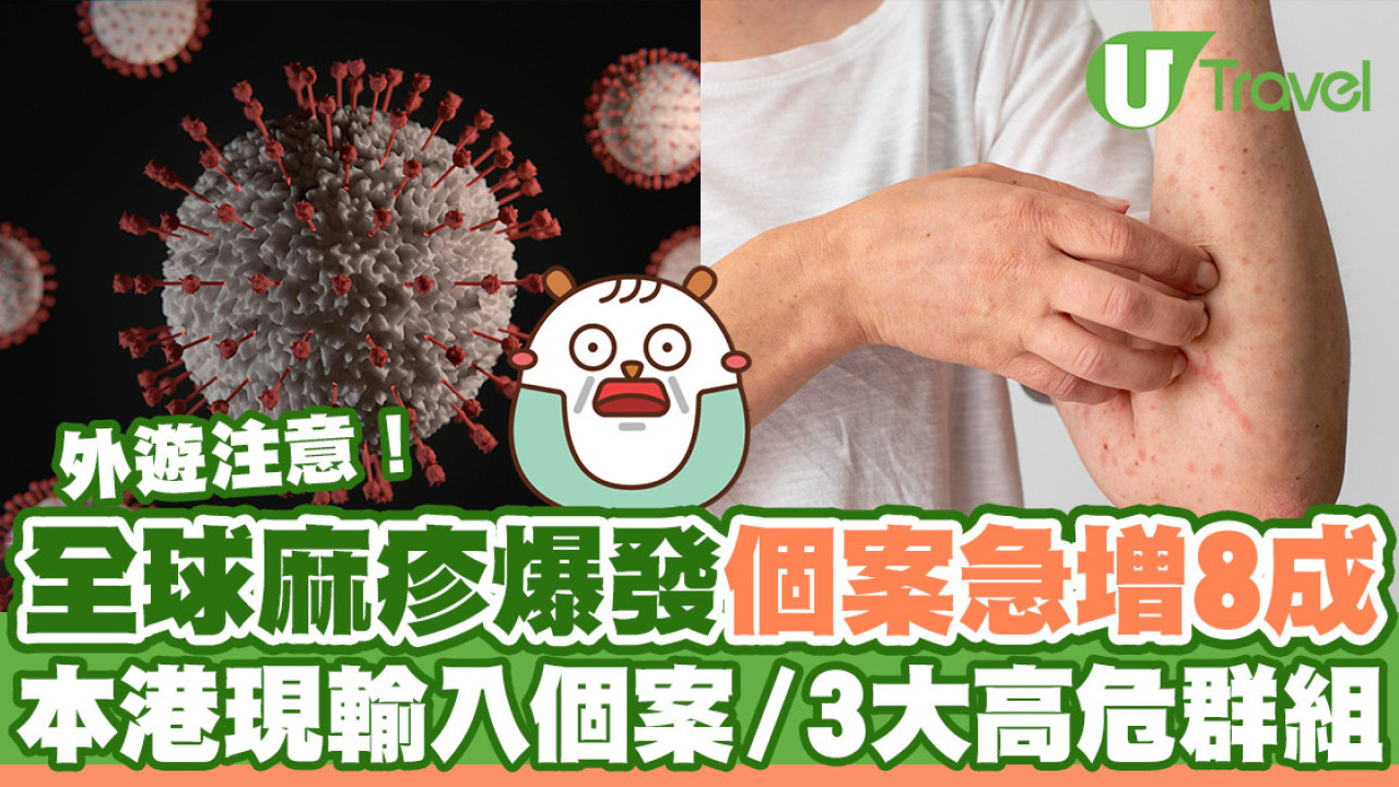 全球麻疹爆發較去年急增近8成！本港現3宗輸入個案／3大高危群組需注意！