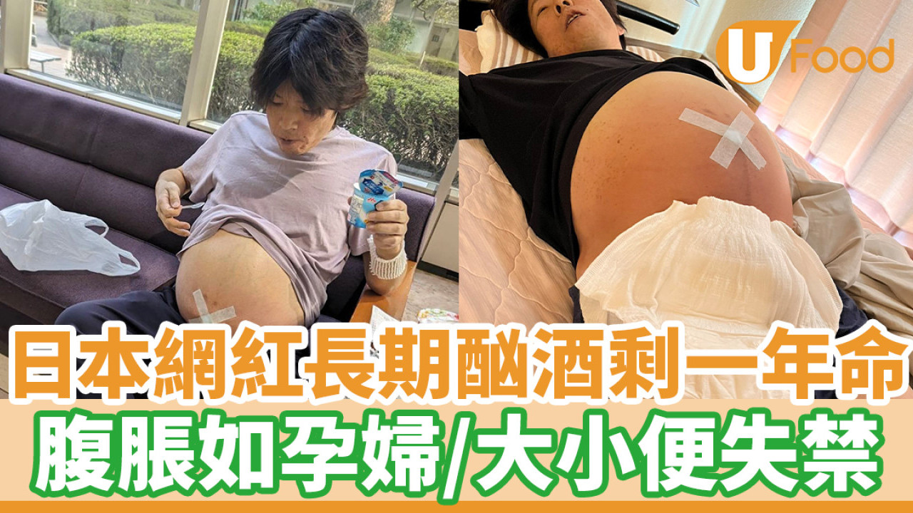 日本網紅長期酗酒剩一年命　腹脹如孕婦／大小便失禁
