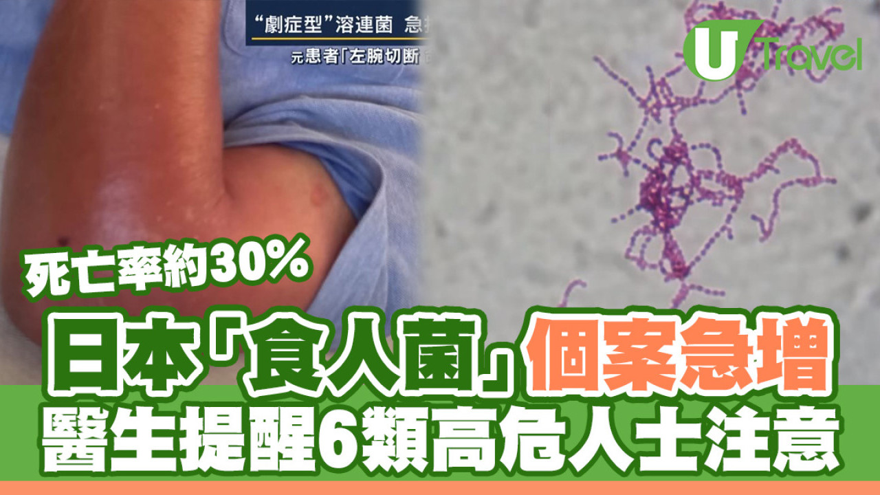日本「食人菌」個案急增 醫生提醒6類高危人士注意