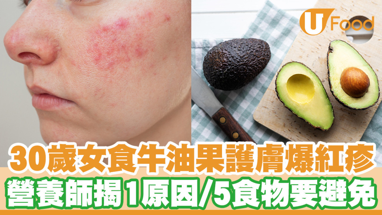 30歲女食牛油果護膚爆紅疹 營養師揭1原因 5類食物要避免