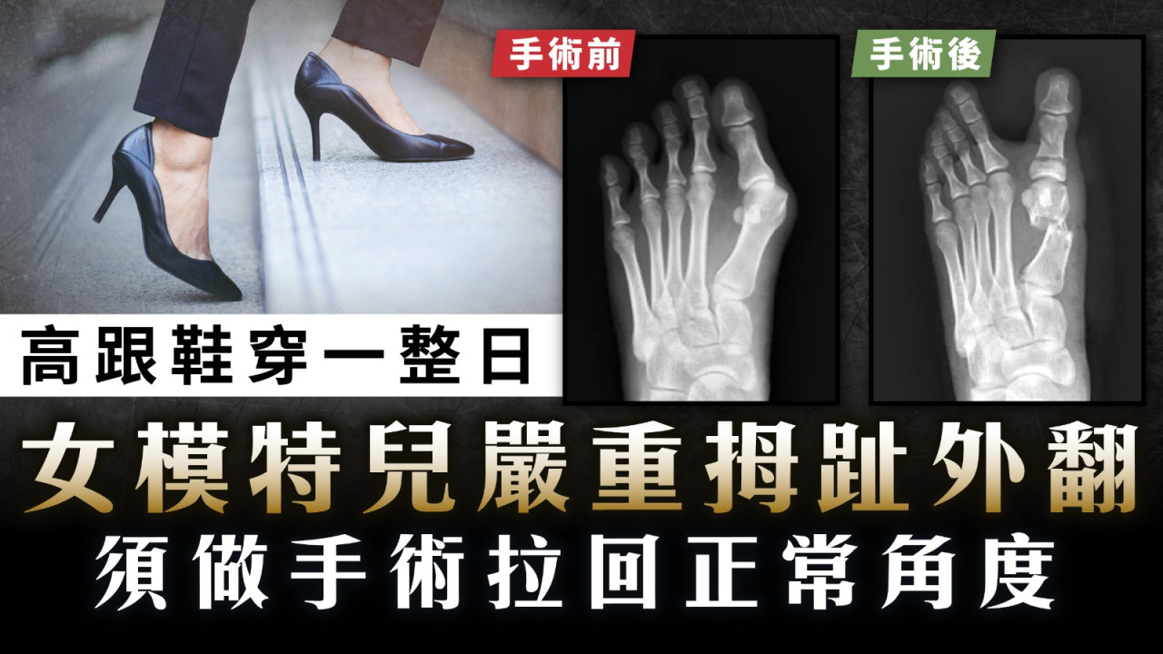拇趾外翻｜高跟鞋穿一整日 女模特兒嚴重拇趾外翻 須做手術拉回正常角度 | UHK 港生活
