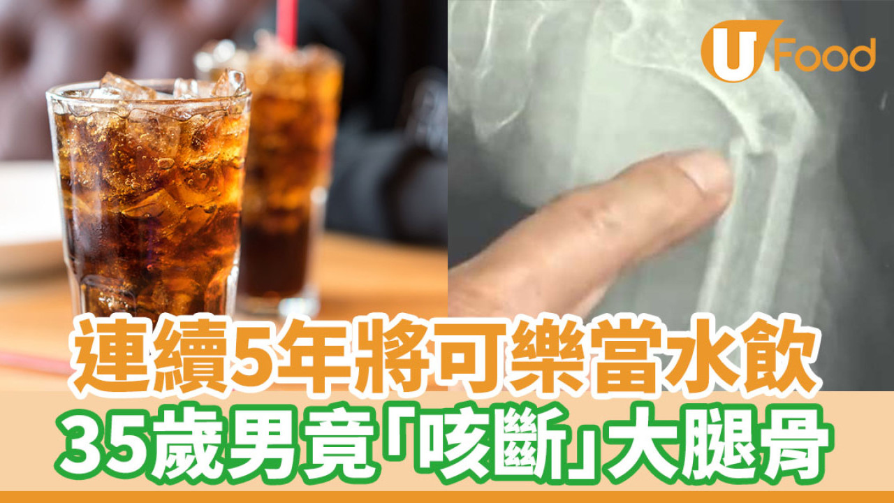 連續5年將可樂當水飲 35歲男竟「咳斷」大腿骨