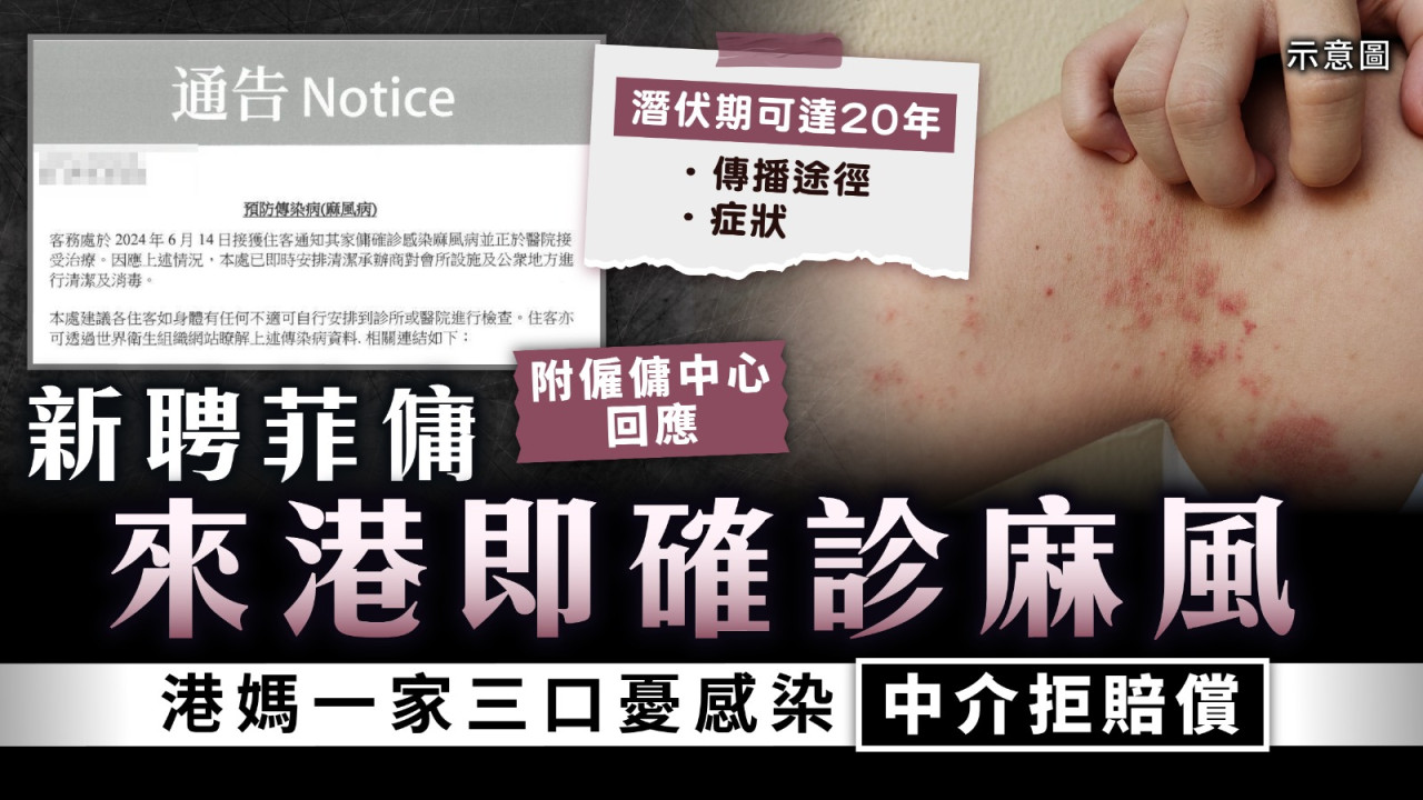 外傭患麻風｜新聘菲傭來港即確診麻風 港媽一家三口憂感染中介拒賠償【附傳播途徑及症狀】 | UHK 港生活