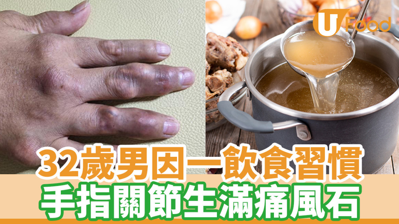 32歲男一個飲食習慣 手指關節生滿痛風石