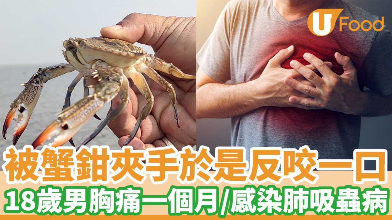 被蟹鉗夾手於是反咬一口 18歲男子感染肺吸蟲病 