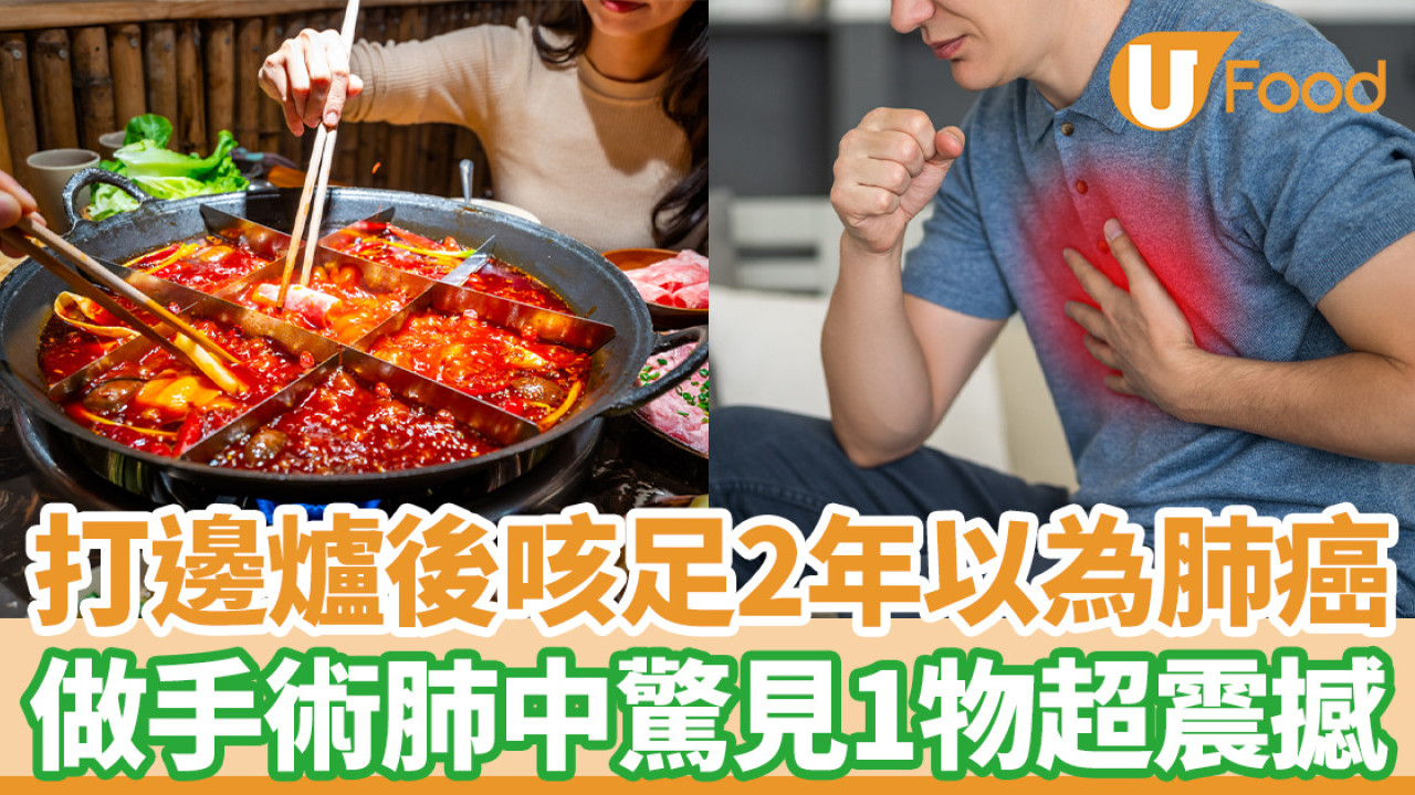 打邊爐後咳足2年以為肺癌 做手術肺中驚見1物超震撼