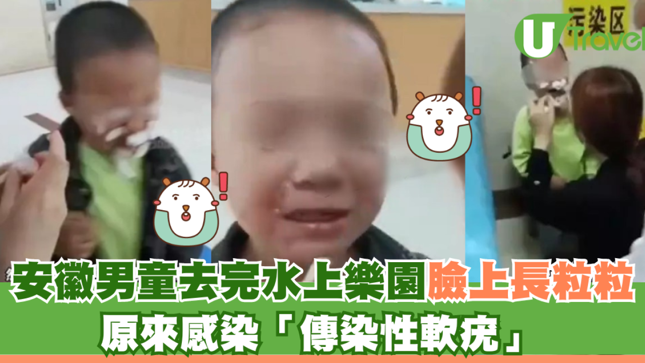 安徽男童去完水上樂園臉上長粒粒 原來感染「傳染性軟疣」 