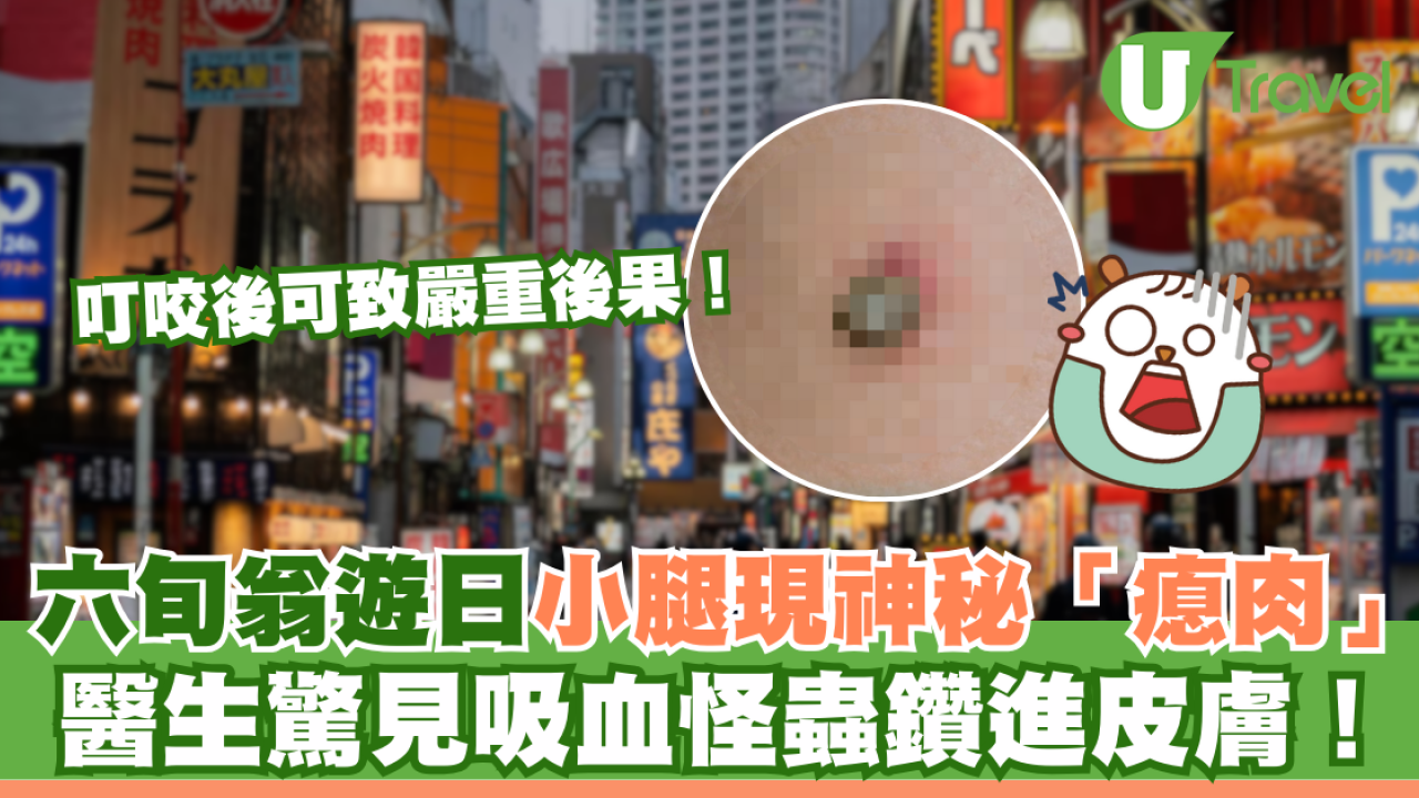 六旬翁遊日本後小腿現神秘黑色「瘜肉」 醫生證竟是吸血怪蟲鑽進皮膚