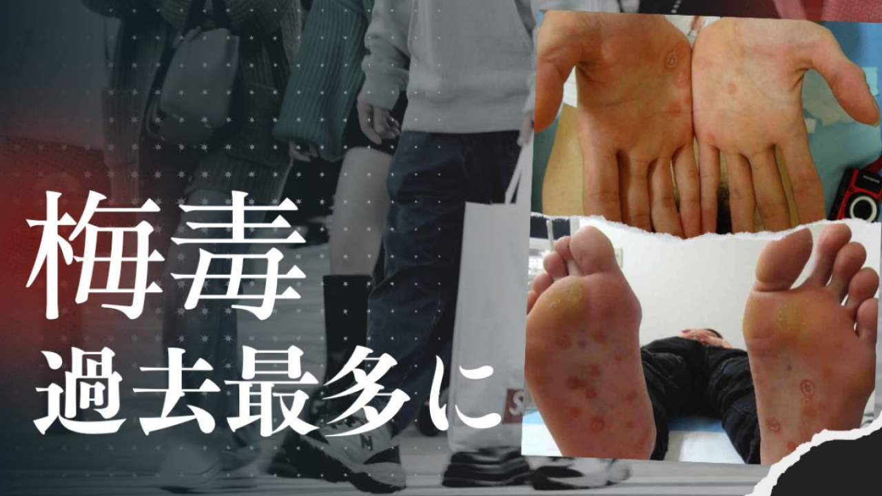 日本梅毒｜東京梅毒極速傳播破2400人感染！4階段症狀 專家提3招預防