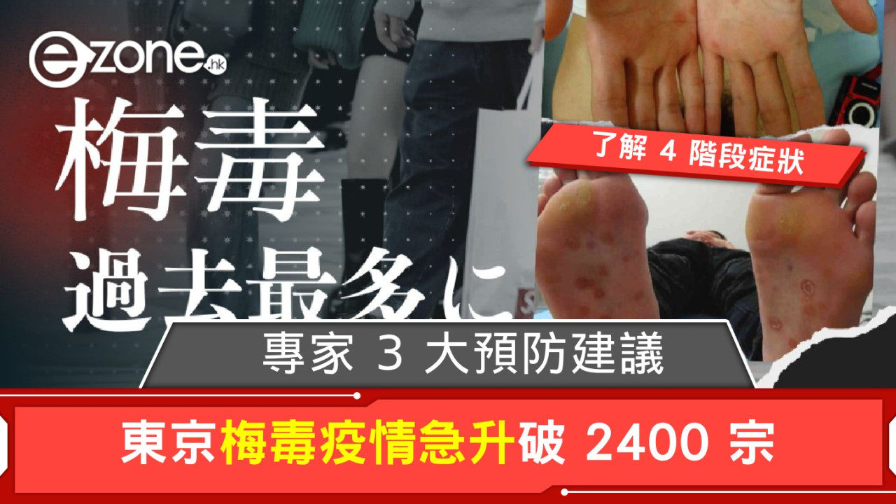 東京梅毒疫情急升破2400宗！了解4階段症狀及專家3大預防建議