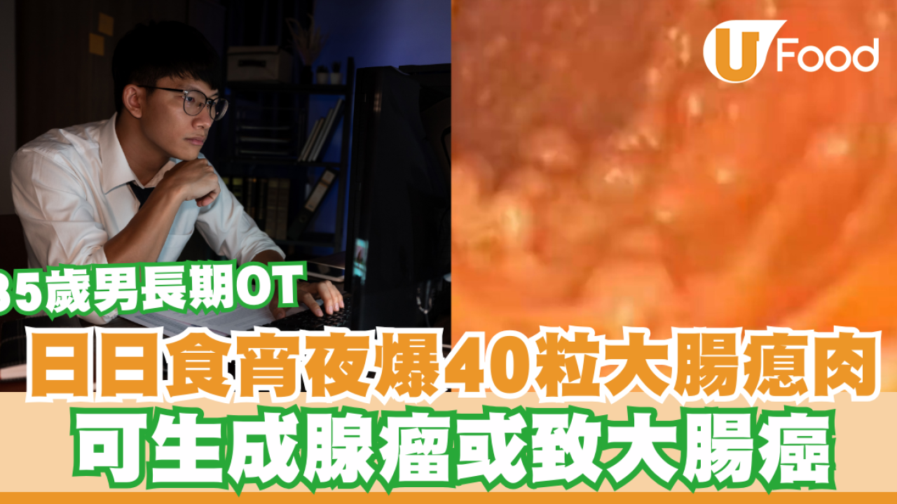 35歲男長期OT食宵夜大腸爆40粒瘜肉！可生成腺瘤或致癌／醫生6貼士防大腸癌