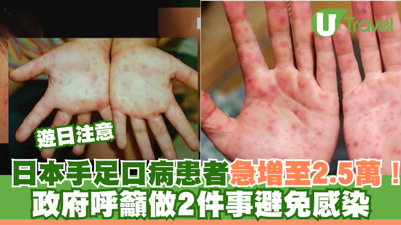 遊日注意｜日本手足口病患者急增至2.5萬！ 政府呼籲做2件事避免感染