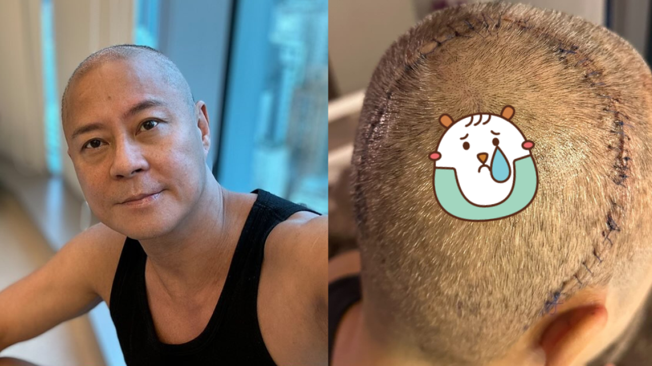 草蜢57歲蔡一傑缺席美國巡唱 驚揭罹腦瘤 PO頭頂巨型傷口報平安