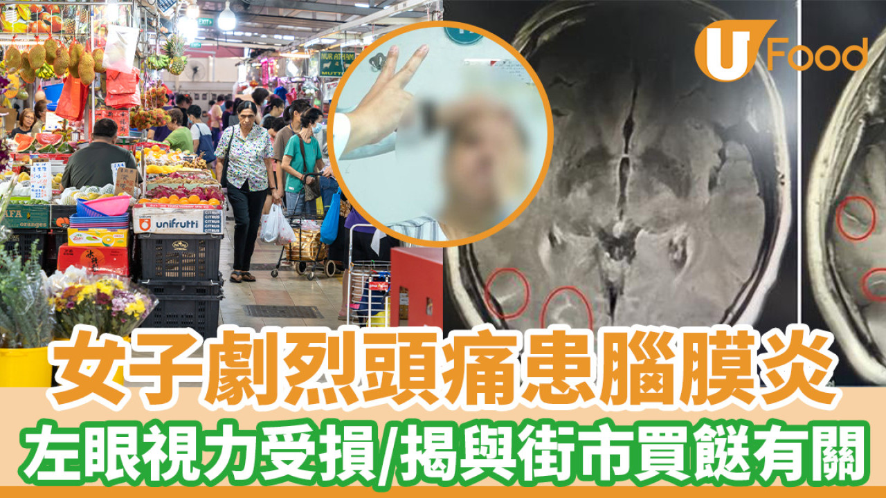 女子劇烈頭痛患腦膜炎 左眼視力受損/揭與街市買餸有關