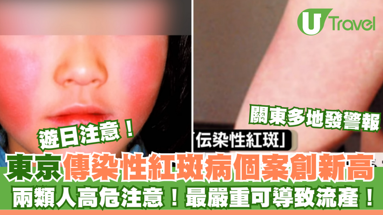 遊日注意｜東京傳染性紅斑病個案創新高 多地發警報 兩類人高危注意！最嚴重可導致流產！