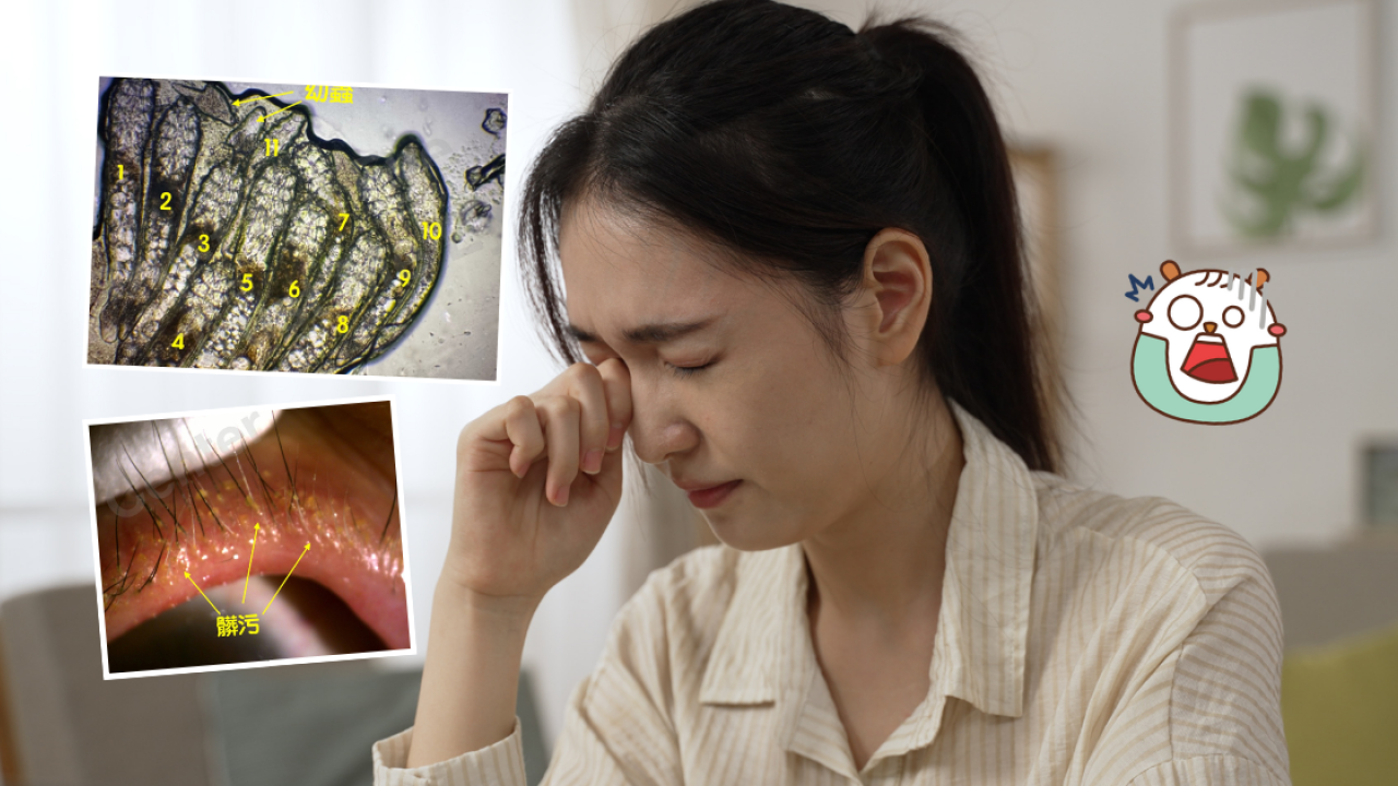女子眼乾痕癢驚揭睫毛藏11條蟎蟲！全因洗面時做漏1步驟