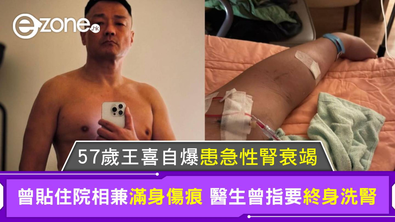57歲王喜自爆患急性腎衰竭 曾貼住院相兼滿身傷痕 醫生曾指要終身洗腎