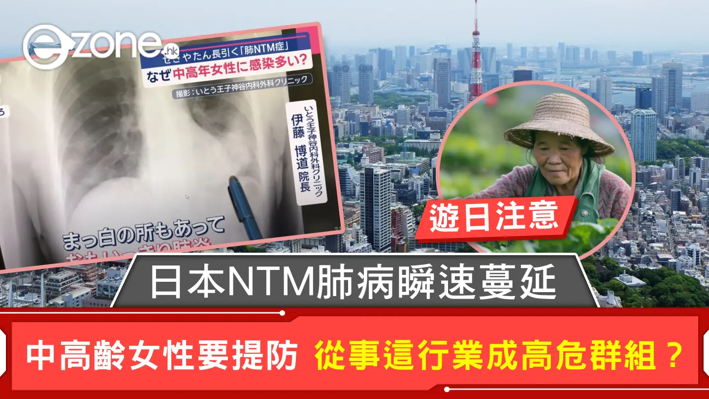 遊日注意｜日本NTM肺病瞬速蔓延 中高齡女性要提防 從事這行業成高危群組？