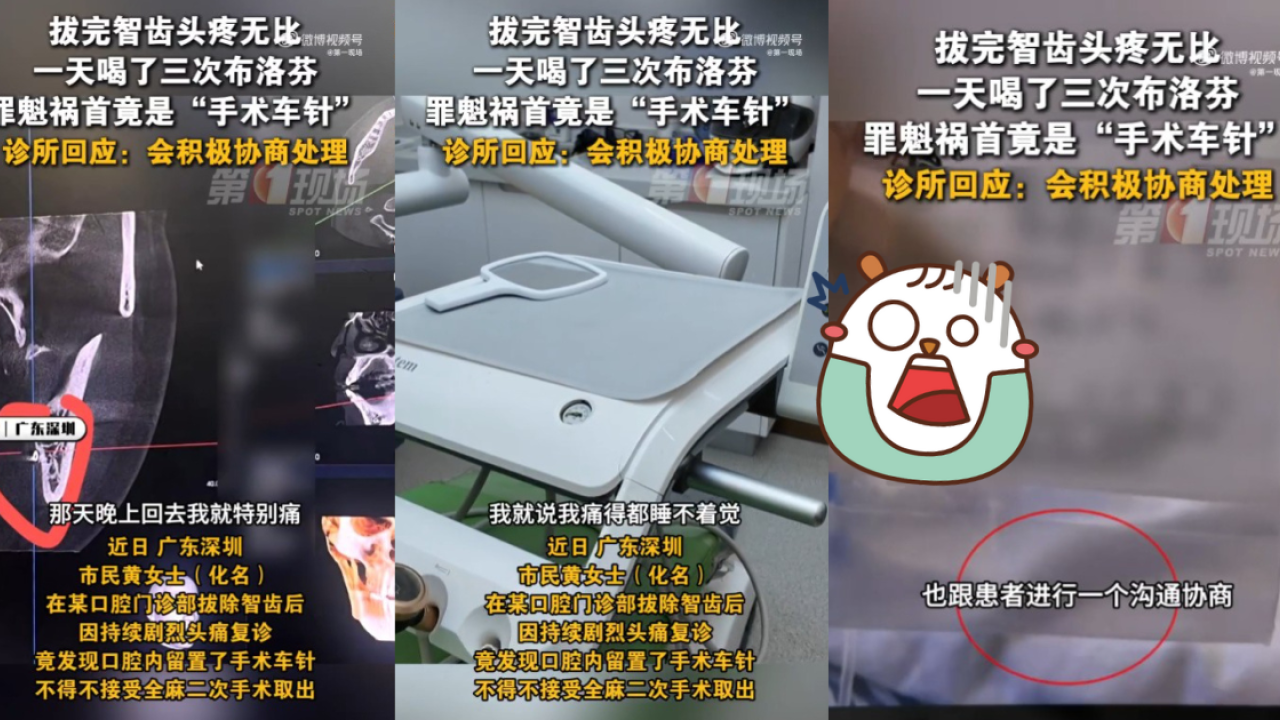深圳福田拔智齒致頭部劇痛多日 覆診驚見口腔殘留手術針
