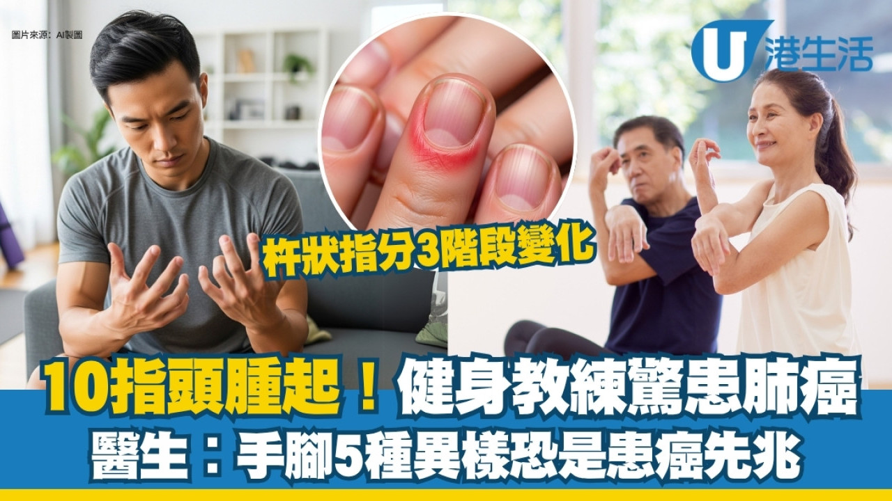 「杵狀指」十隻手指頭腫脹竟是肺癌三期！手腳5種異樣當心早期癌症警號 | UHK 港生活