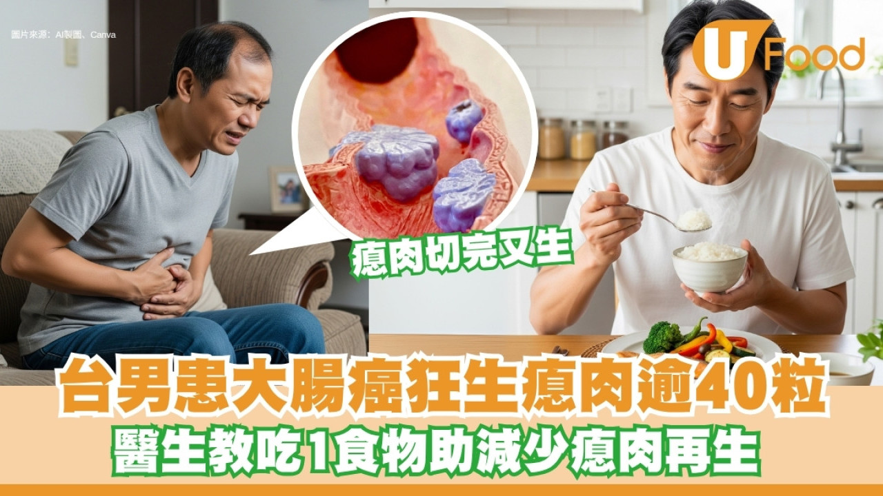 大腸癌︱男子患大腸癌狂生大腸瘜肉逾40粒 醫生教吃1食物助減少瘜肉再生