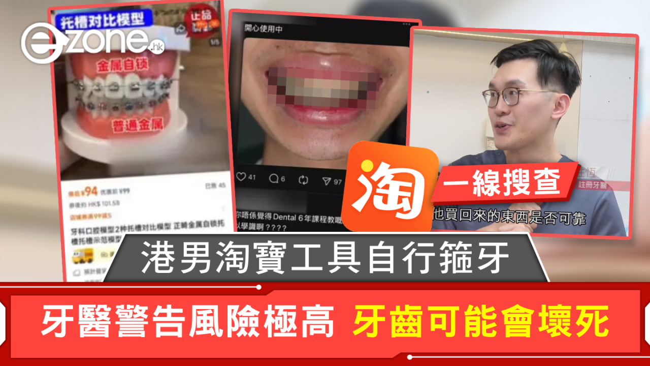 一線搜查｜港男淘寶工具自行箍牙 牙醫警告風險極高 牙齒可能會壞死