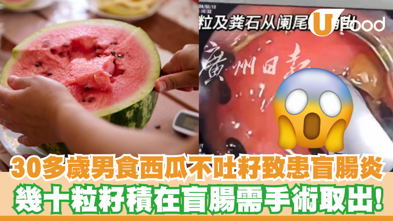 30多歲男食西瓜不吐籽致患盲腸炎！幾十粒籽積在盲腸需手術取出